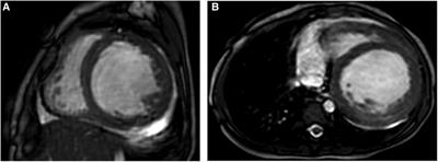 The value of cardiac magnetic resonance imaging in endocardial fibroelastosis